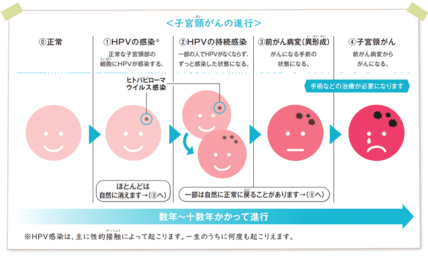 子宮頸がんの進行