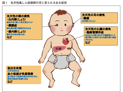 先天性風疹症候群