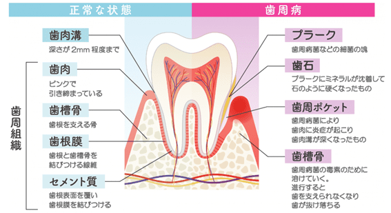 歯周病とは